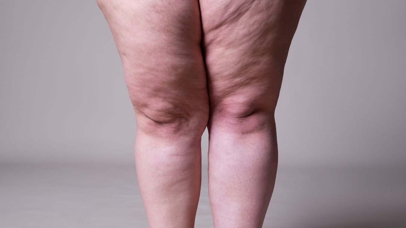 auxilio da nutrição no tratamento do lipedema