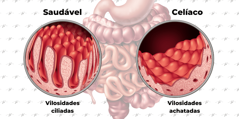 doença celíaca vilosidades