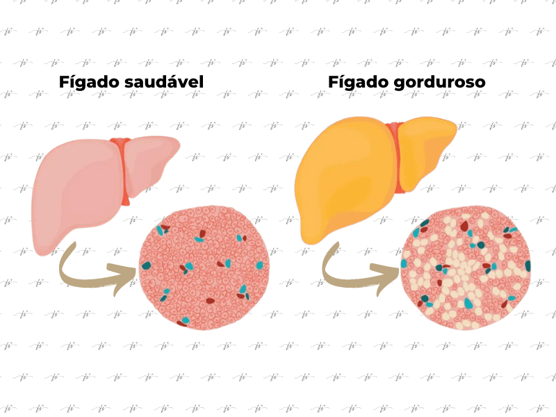fígado saudável versus fígado gorduroso